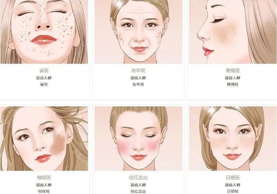 激光美容合适人群