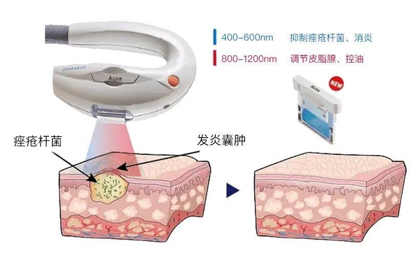 Acne痤疮滤光片作用 Acne痤疮滤光片作用
