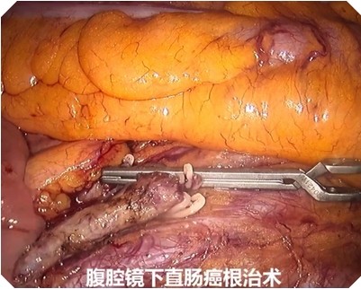 腹腔镜下直肠癌无荧光成效