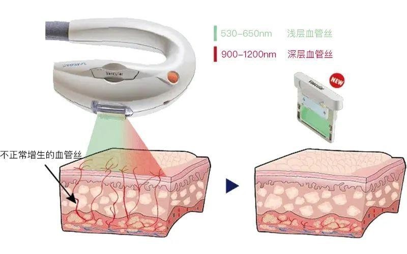 超光子中的血管滤光片作用皮肤